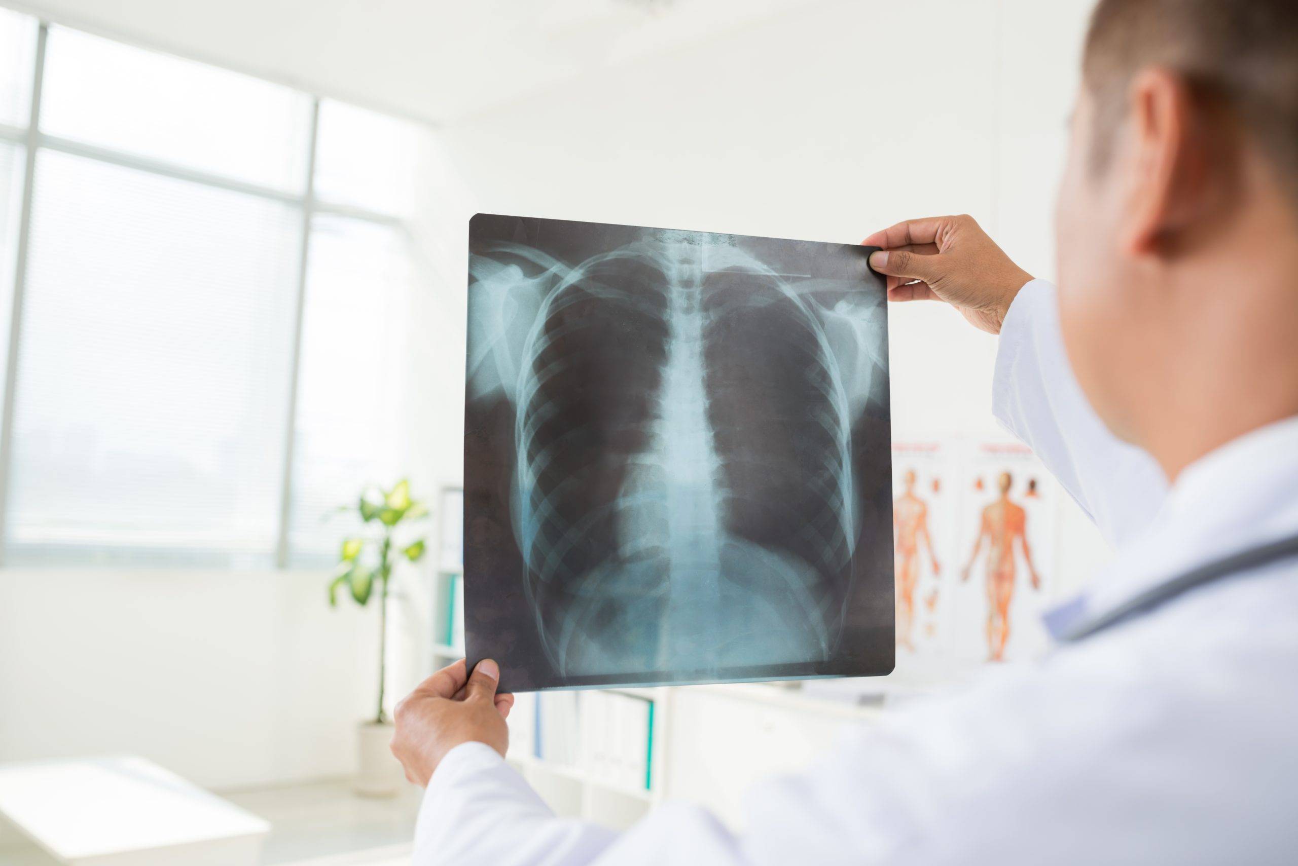 Akciğer Nakli: Son Çare Olarak Uygulanan Bir Tedavi